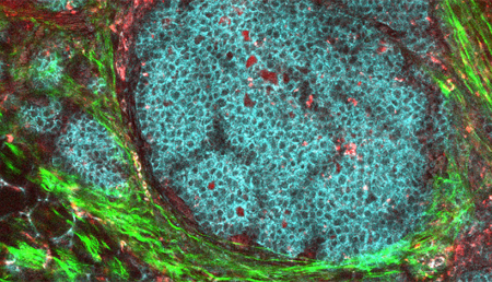 La disminución de la proteína ZEB1 induce el envejecimiento de las células tumorales