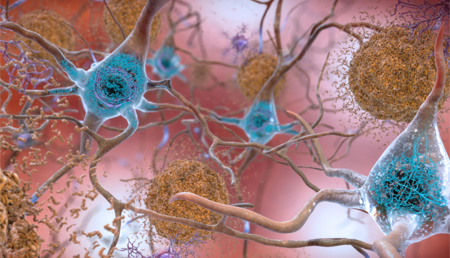 Investigadores analizan los procesos de la enfermedad de Alzheimer con luz de sincotrón