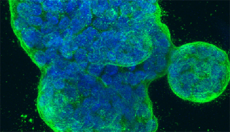 Identifican una proteína que podría mantener dormidas las células metastásicas del cáncer de mama