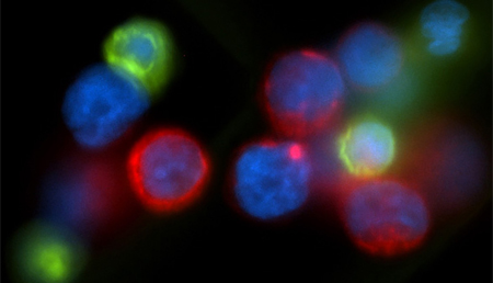 La secuenciación de ARN y ADN podría revelar los primeros impulsores del cáncer de mama metastásico