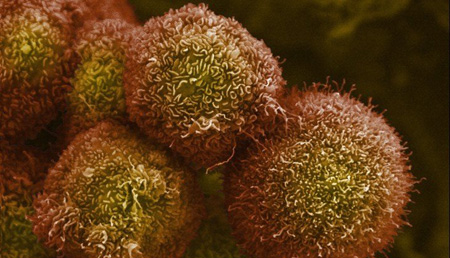 Mutaciones de cuatro genes podrían asociarse a una peor supervivencia en cáncer de páncreas