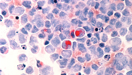 Un nuevo test genético permitirá diagnosticar leucemias de células B que hasta ahora no se podían clasificar