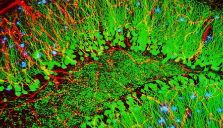 Un estudio podría relacionar los trastornos vasculares con la enfermedad de Alzheimer