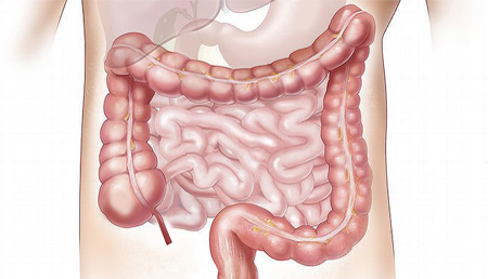 Identificados dos marcadores relacionados con la alteración de la permeabilidad epitelial en el intestino irritable
