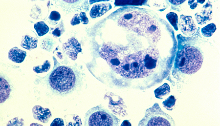 El factor SOX11 podría favorecer las recaídas en linfoma de células del manto