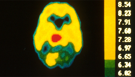 Un estudio permite entender mejor cómo se alimentan los tumores cerebrales