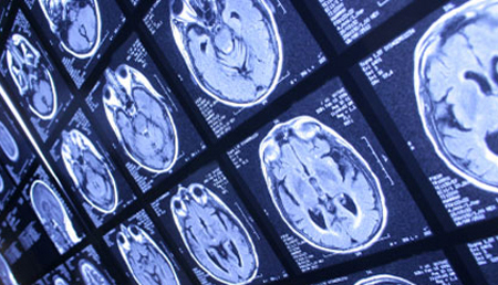 Identifican cambios estructurales en el cerebro vinculados al deterioro cognitivo asociado al Parkinson