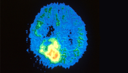 Investigadores del IIS Biodonostia identifican un gen clave en el desarrollo del tumor cerebral más común 